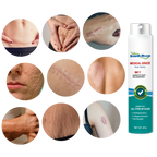 Scar Removal Spray Therapy